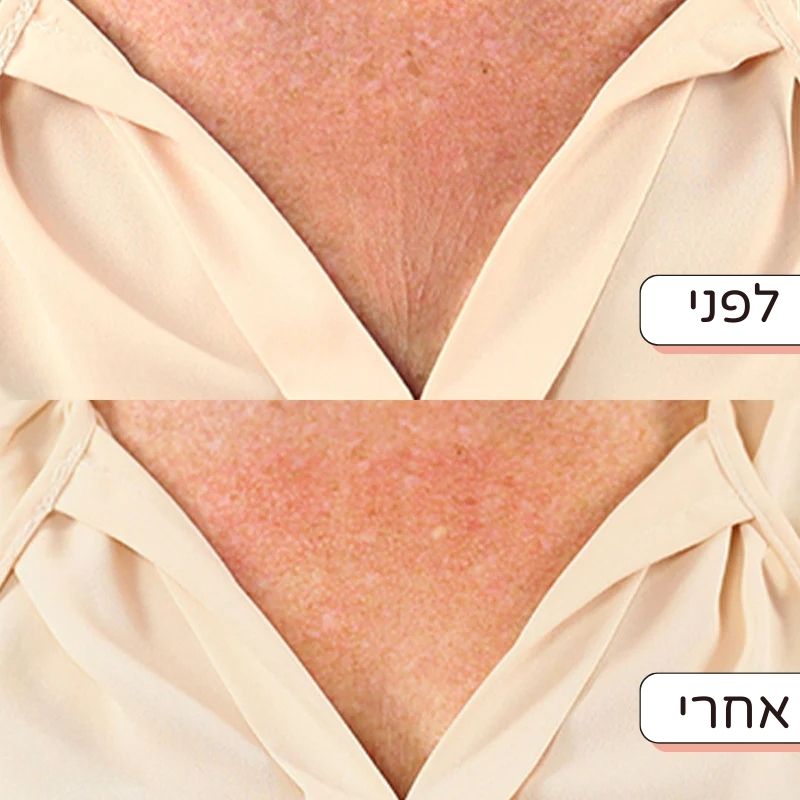 מדבקת חידוש העור נגד קמטים לחזה - Dayli