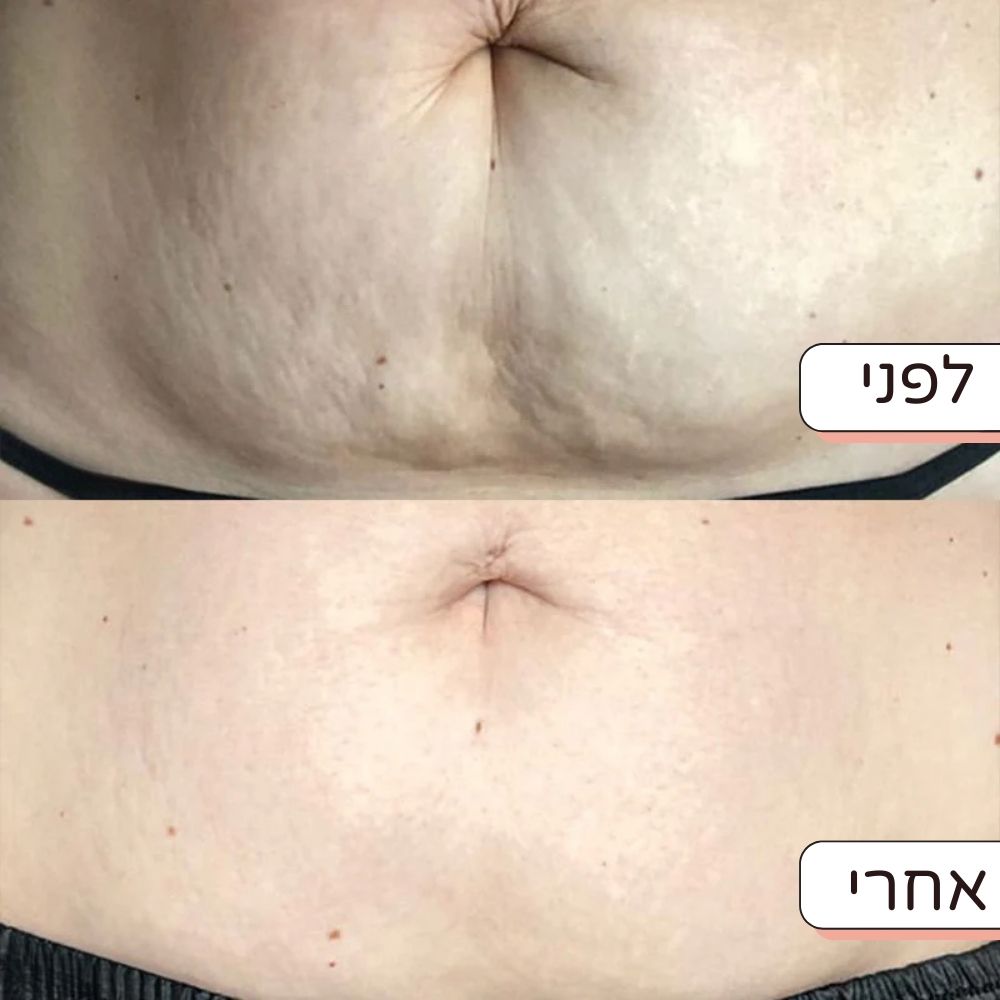 מדבקת חידוש לבטן הריונית - נגד סימני מתיחה וצלקות - Dayli