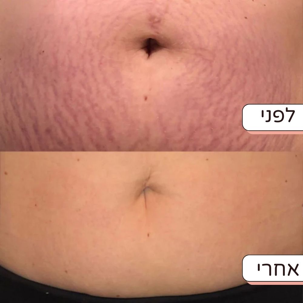 מדבקת חידוש לבטן הריונית - נגד סימני מתיחה וצלקות - Dayli